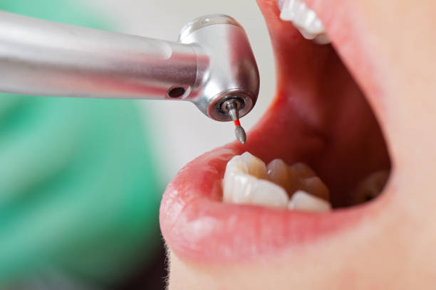 Best Emergency Root Canal Treatment in Ansonia, OH